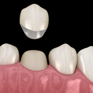 Implant Care